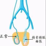 精索静脉曲张3D腹腔镜是理想的治疗方法