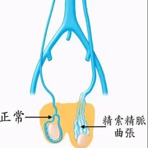 精索静脉曲张
