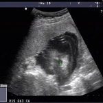 四维彩超确诊豁唇