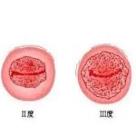 宫颈细胞学检查tct是怎么回事？