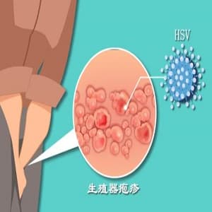生殖器泡疹