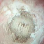 热球去除尿毒症子宫增生出血