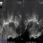 子宫肌瘤消融术后再长九个瘤子救助于安太院长