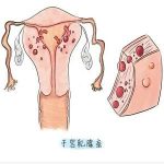 子宫腺肌症(肌腺症)是怎么一回事？