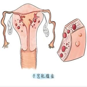 子宫腺肌症