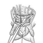 先天膀胱外翻 尿失禁13年 ­
