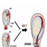 胎膜早破-羊膜破洞修补法