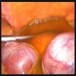 多囊卵巢自行促排引发卵巢过激