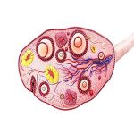 卵巢畸胎瘤与不孕：解密先天性疾病的治疗与影响