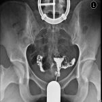 解密输卵管过细：不是不孕的独一原因