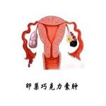 【视频】如何治疗巧克力囊肿以提高孕育成功率？