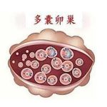 [视频]多囊卵巢综合症患者不孕问题解决方案：卵睾挫灭术