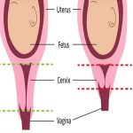 【视频】晚期流产的预防和治疗