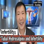 Hydrosalpinx and Infertility:The Importance of Accurate Diagnosis and Individualized Treatment