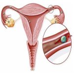 Tuberculosis and Tubal Infertility: Hope for Cure and the Option of Surrogacy