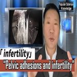 The Issue of Infertility Caused by Postoperative Pelvic Adhesions